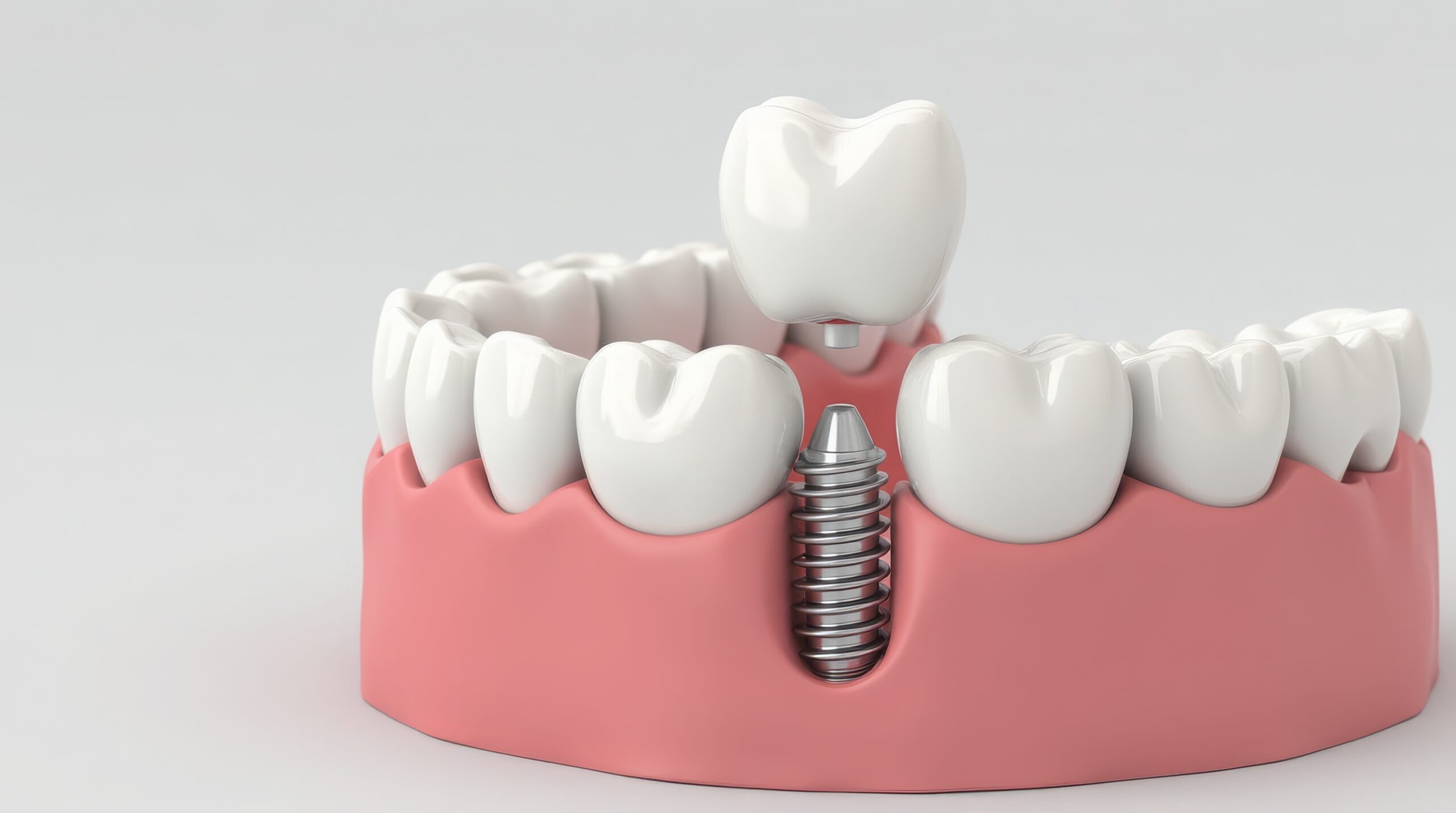 All-on-4® Dental Implant Solutions